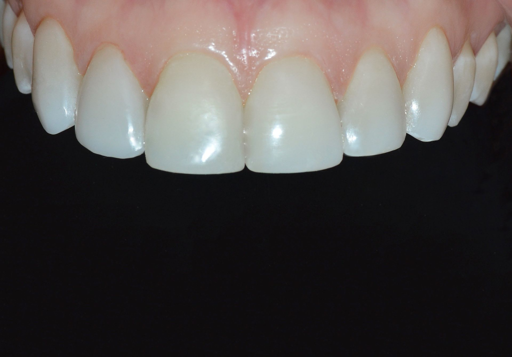 Antes